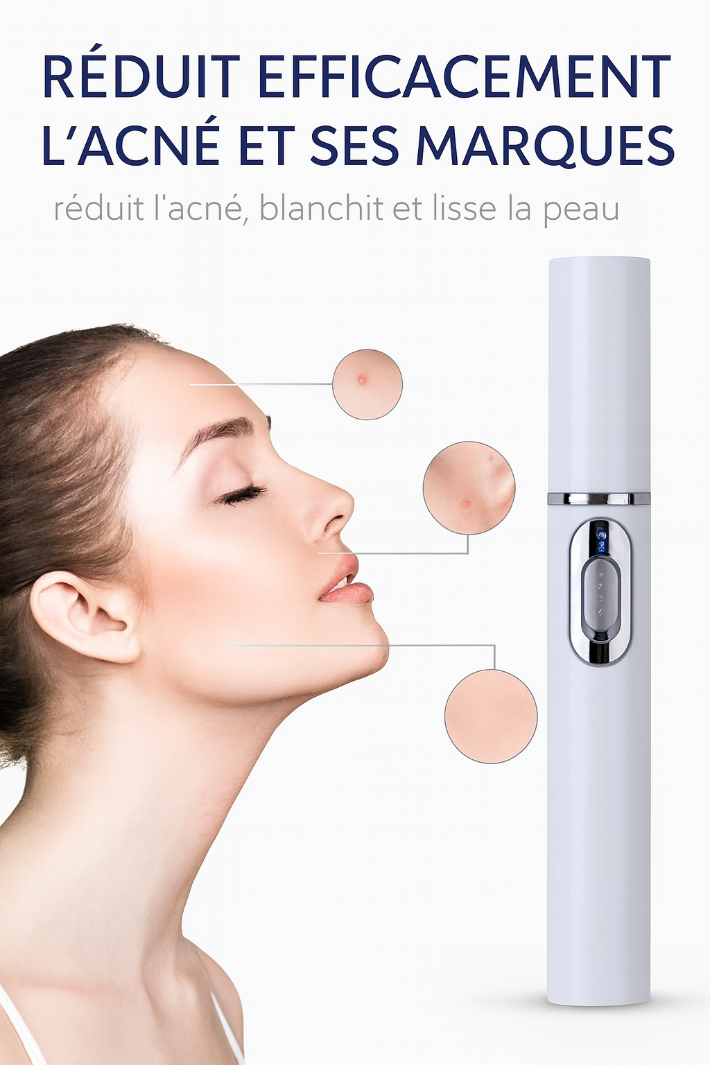 Stylo laser à lumière bleue pour le traitement de l’acné — appareil de soin de la peau pour atténuer les cicatrices, lisser